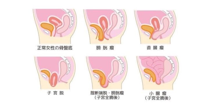 骨盤臓器の位置のイラスト